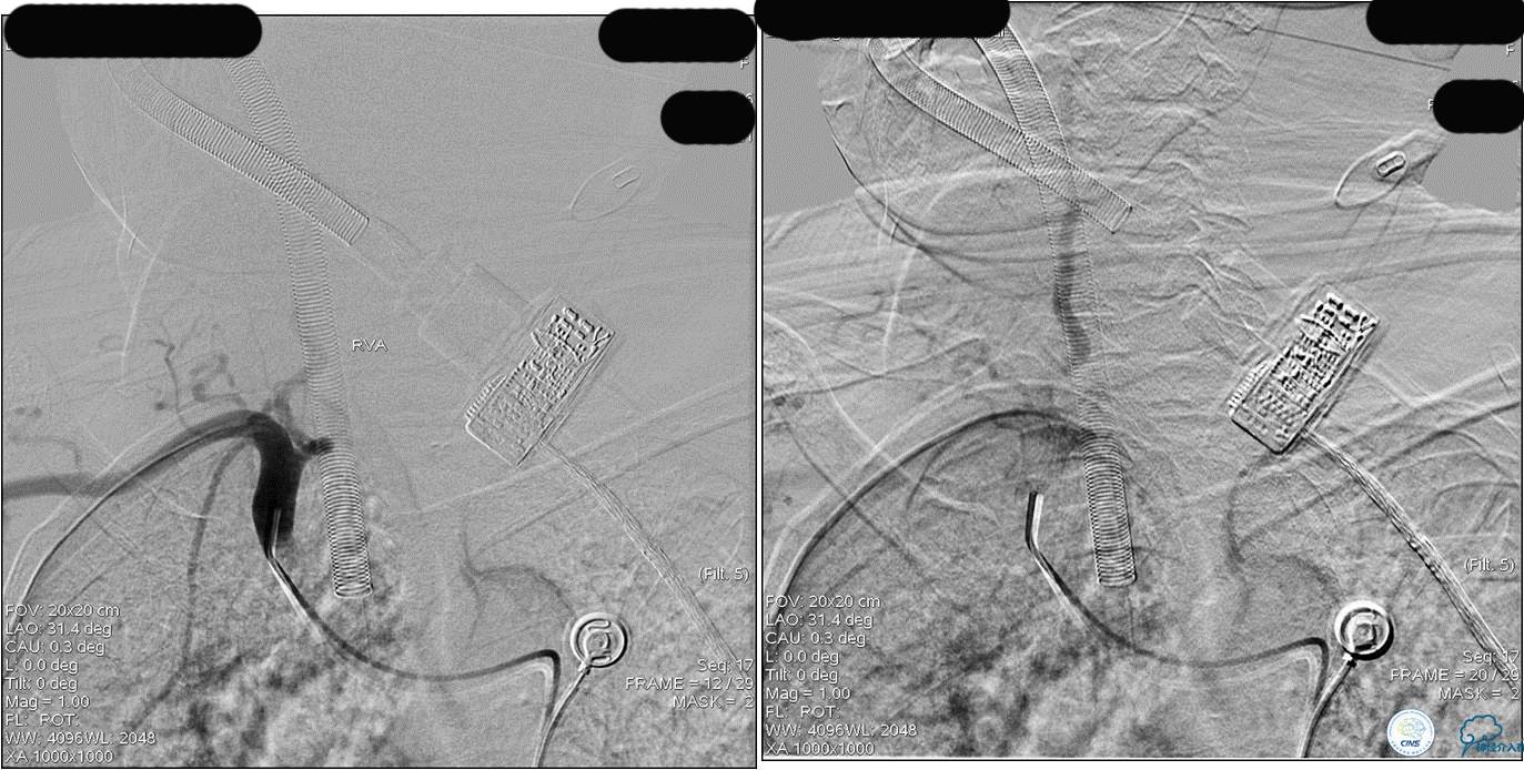 冠状动脉慢性闭塞的介入治疗,颅外段锥动脉狭窄的介入治疗