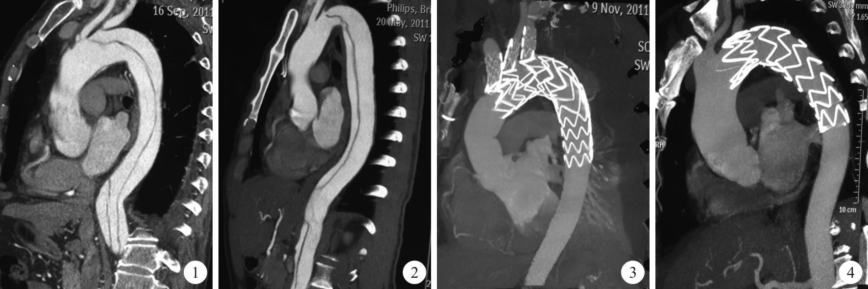 美国治疗主动脉夹层,倪海厦治疗主动脉夹层