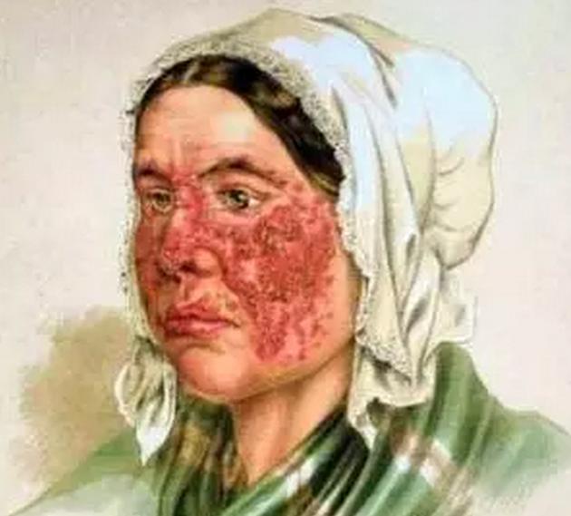 红斑狼疮肾炎怀孕了要注意什么,红斑狼疮吃三颗激素药可以怀孕吗