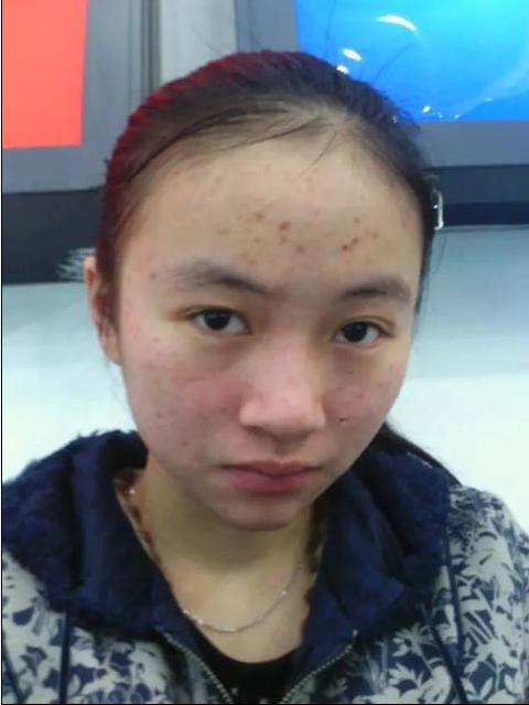 常年长痘的皮肤怎么调理回来,经常长痘如何快速消除