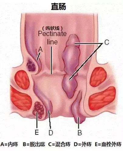 三个治愈痔疮的神奇秘方,真正治愈痔疮最好的几个方子