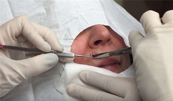 医生从她人中上的不明肿瘤一刀切下去后，这东西竟然蹦出來！慎入