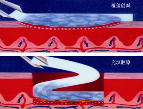 海藻酸钠医用敷料怎么使用,海藻盐敷料有什么效果