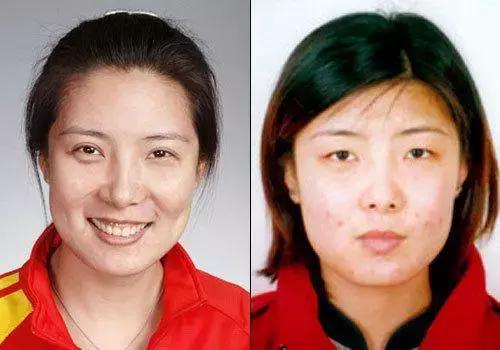 奥运冠军也爱美瘦脸箍牙后她们都美啦