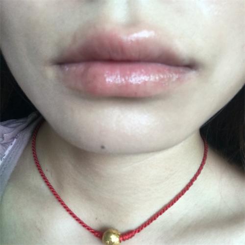 剥脱性唇炎最佳治疗方法,剥脱性唇炎吃什么食物好得快