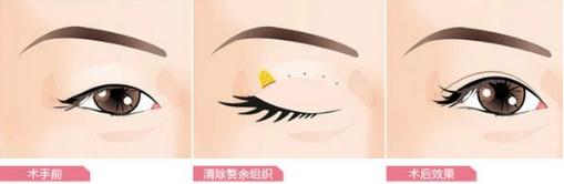 师丽丽开讲第四期：上睑下垂怎么治疗?