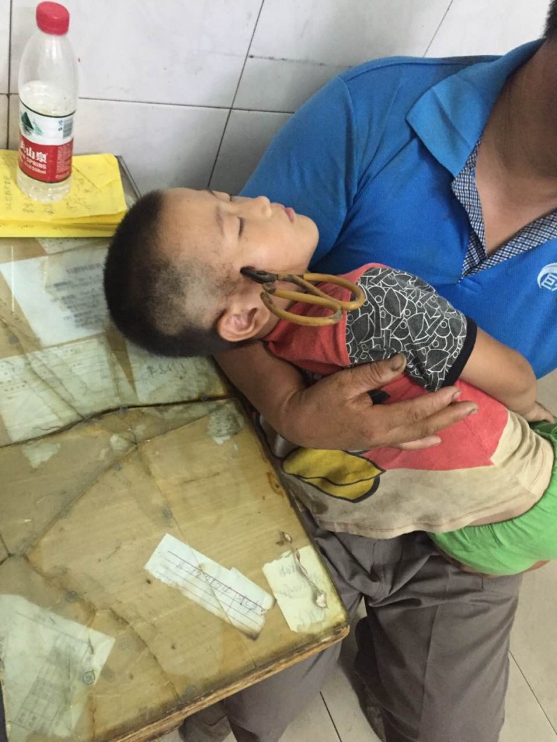 男童被剪刀刺伤致大动脉破裂出血,太阳穴被剪刀刺伤会怎么样