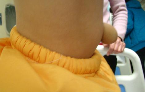 3岁女孩腹股沟有个包块不疼,4岁女孩腹股沟疝有点鼓包