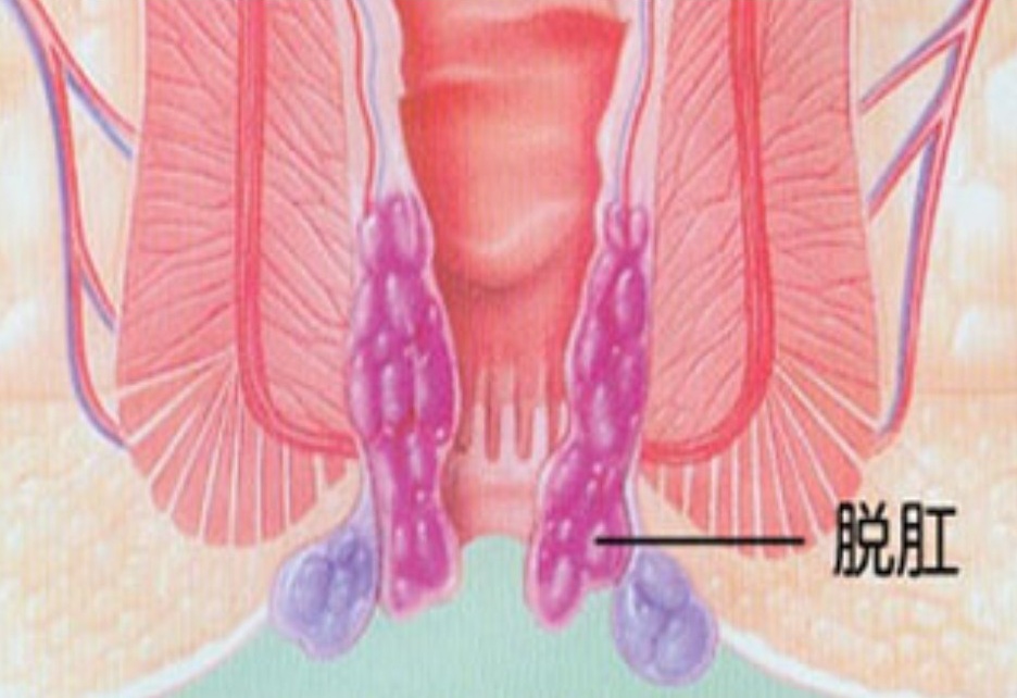 儿童脱肛偏方,儿童脱肛秘方