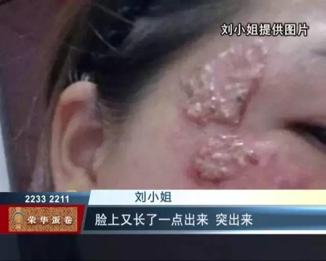 药水祛斑会癌变吗,药水祛斑的危害与效果