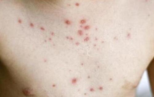 治疗皮肤病湿疹有什么办法,武汉皮肤病湿疹止痒秘方