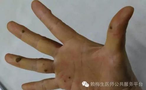 火针灸能治跖疣吗,中医火针治疗丝状疣