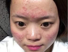 去掉额头上的痘痘用什么药膏,如何让额头上的痘痘消失