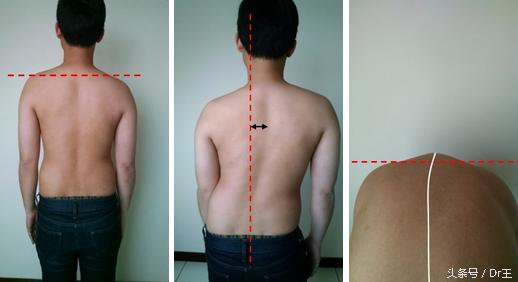 脊柱侧弯治疗费用,脊柱侧弯的几大治疗流派