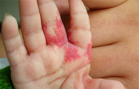 如何正确认识血管瘤,新生儿血管瘤怎么预防