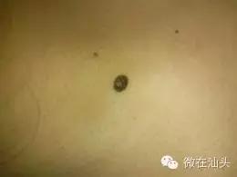 点痣会引发痣癌变吗,痣旁边长了小痣是不是癌变