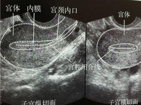月经第15天卵泡1410mm正常吗,经期第13天卵泡多大