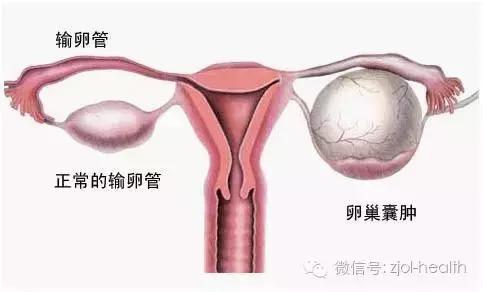 生完孩子卵巢摘除,妈妈切除子宫和卵巢