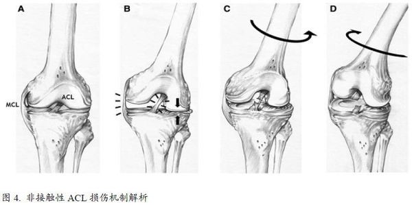 前交叉韧带1-2度损伤能自愈吗,前交叉韧带损伤一年还疼怎么回事
