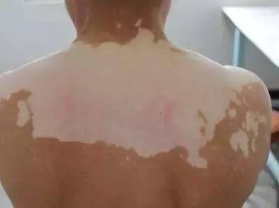 白癜风中医辨证分型施治,白癜风严重了怎么办