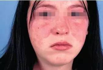 关于红斑狼疮的一些问题,中医对红斑狼疮的病因分析