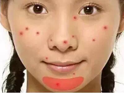 为什么下巴两边的痘痘反复长,为什么脸颊和三角区痘痘多