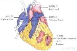 心肌重构能够有效逆转吗,心梗后多长时间心肌重构