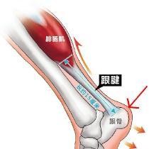 足球运动员跟腱受伤如何治疗,足球运动员跟腱炎一般几天能好