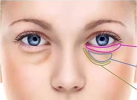 怎么去除黑眼圈又简单又有效,有什么去除黑眼圈的好办法