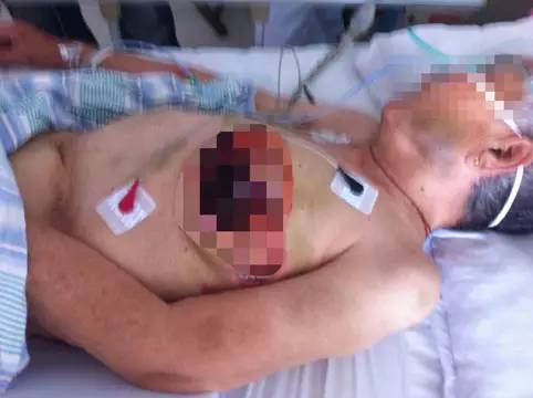 惨不忍睹！东营76岁老人疑遭儿媳虐待！乳房被烙铁烫平肋骨断裂