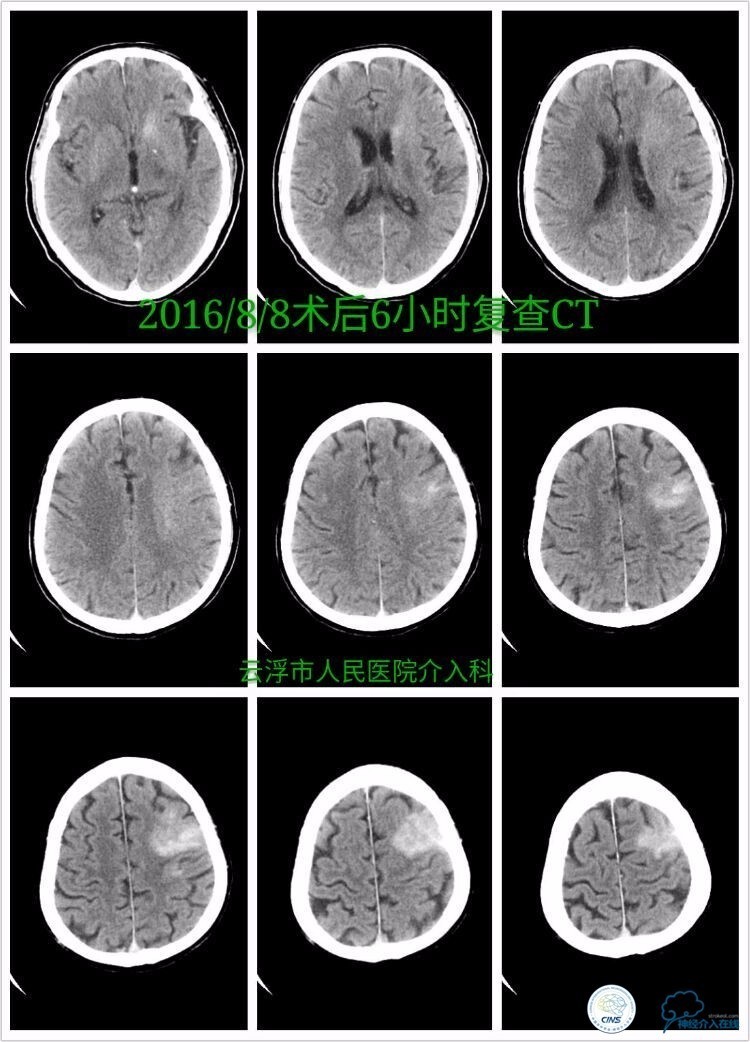 脑血管介入培训基地,脑卒中血管介入治疗