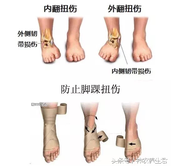 十大常见运动损伤部位及防治,运动损伤最容易出现部位