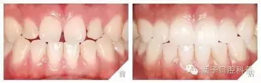 前牙有缝有什么说法吗,前牙有洞怎么补救