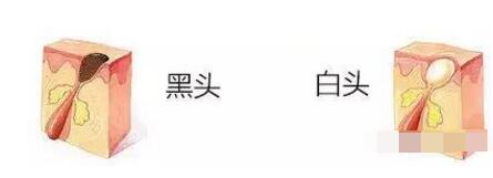 脸上粉刺黑头痘痘毛孔粗大怎么办,黑头闭口毛孔粗大一次性解决