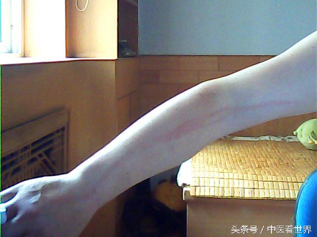 身体出现红色小点是什么病,皮肤上出现红色血管线