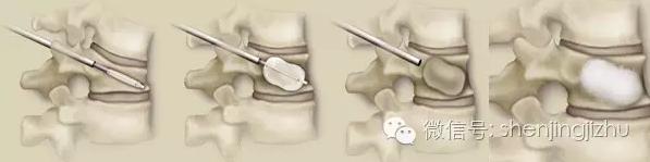 骨质疏松会导致脊柱压缩性骨折吗,骨质疏松脊柱压缩骨折治疗方法