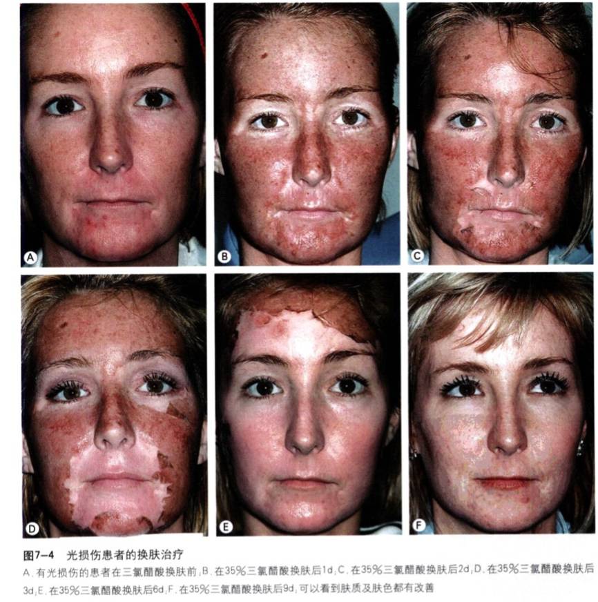 果酸换肤方法,果酸换肤让皮肤焕然一新