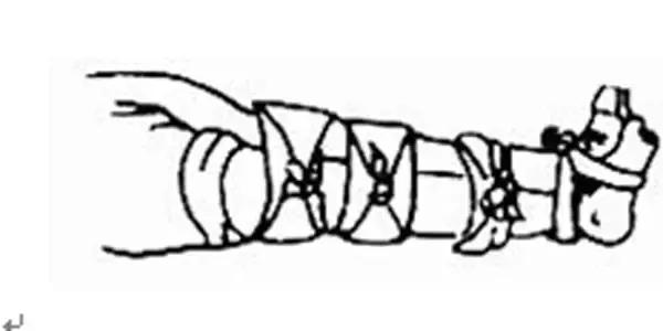 腿部骨折急救方案,骨折的现场急救