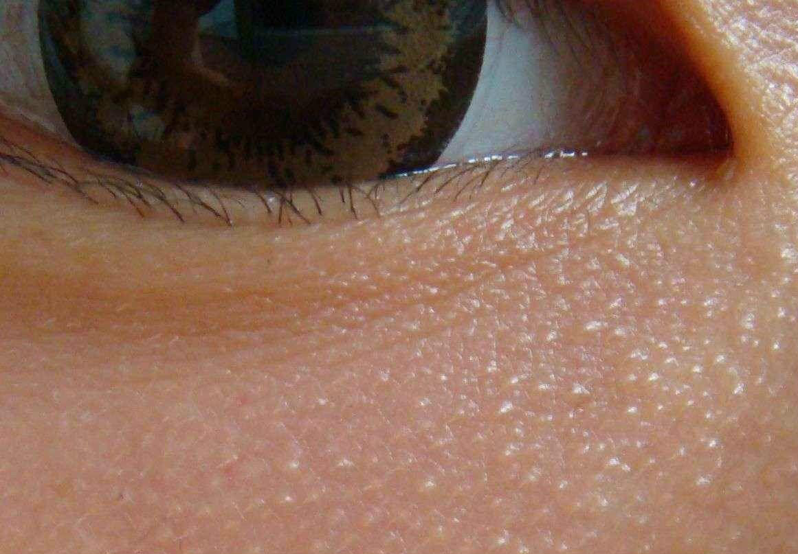 眼睛上边有个小颗粒,眼睛上有个米粒大小的颗粒