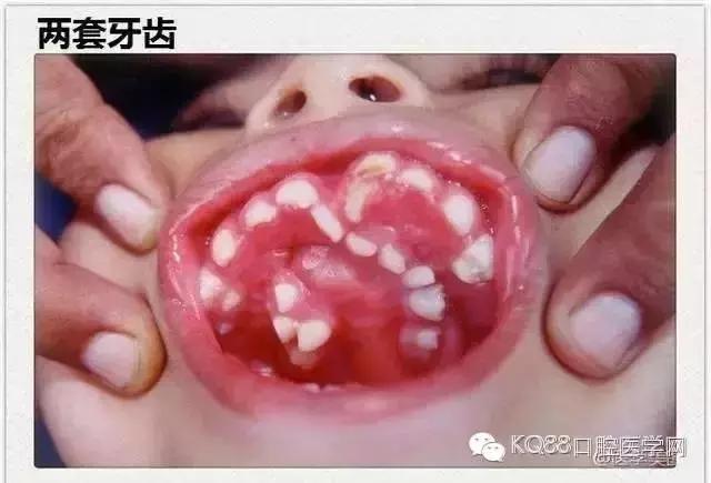 小孩的牙齿怎么会长两层,小孩怎么才能长出好看牙齿