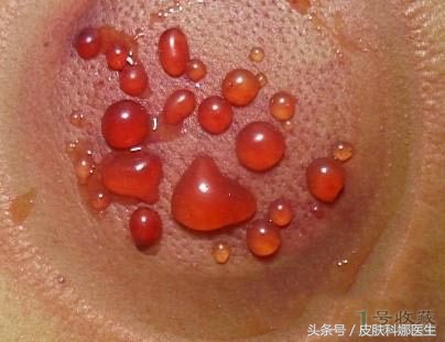 拔火罐结果拔出满身大泡,拔火罐没有拔出湿气可以重新拔吗