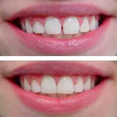 前牙有缝有什么说法吗,前牙有洞怎么补救