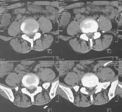 微创手术治疗腰椎间盘突出成功率,目前最热门腰椎微创技术椎间孔镜