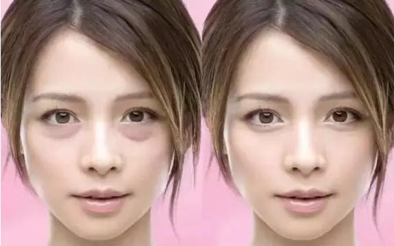 熊猫眼黑眼圈用什么眼霜好,专治熊猫眼的眼霜