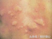 剧烈运动后为什么会出现荨麻疹,一运动就起荨麻疹是什么原因