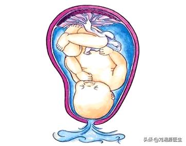 胎膜早破出血保胎成功案例,免疫问题会导致胎膜早破吗