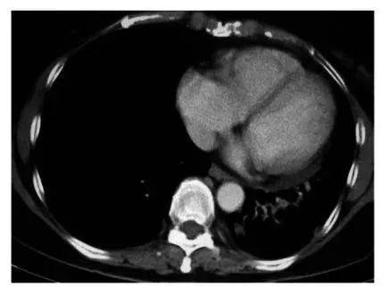 癌症疫苗最新研发消息,癌症疫苗或将问世
