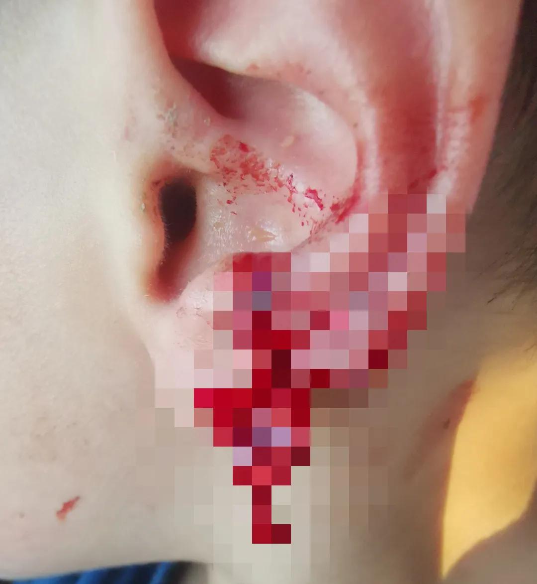 小孩耳垂根部裂开一道口子,孩子耳垂裂开了一条缝