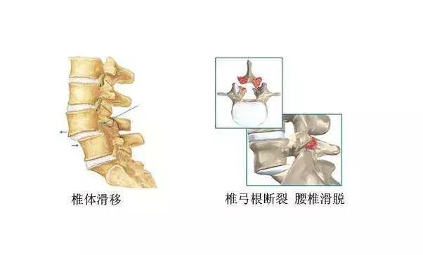 什么是滑脱腰椎,哪家医院治疗腰椎滑脱症最好