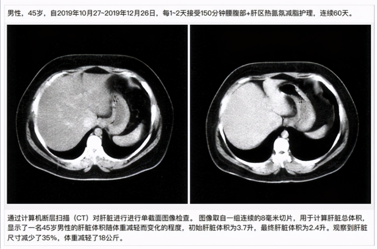 美容院必备｜热氤氛真正健康的减内脂设备